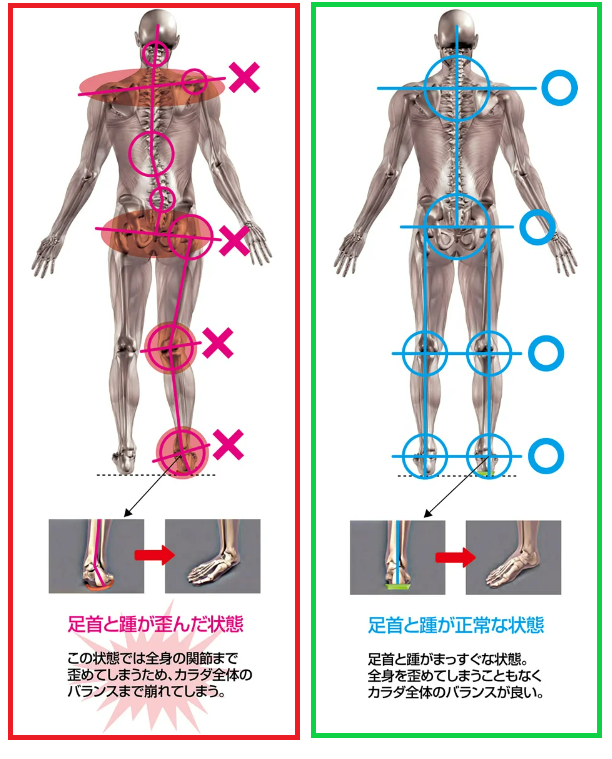 骨格矯正を促すインソール2.png